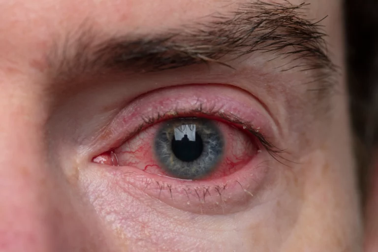 Weed Eyes & Other Side Effects of Marijuana