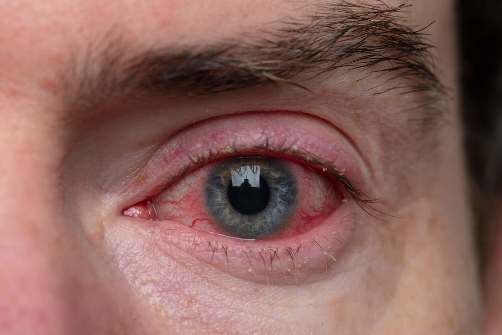 However, bloodshot eyes aren't the only side effect of cannabis.