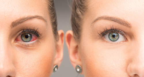 Marijuana causes red eyes because THC (tetrahydrocannabinol) reduces your blood pressure, which causes your capillaries (the blood vessels in your eyes) to dilate. 